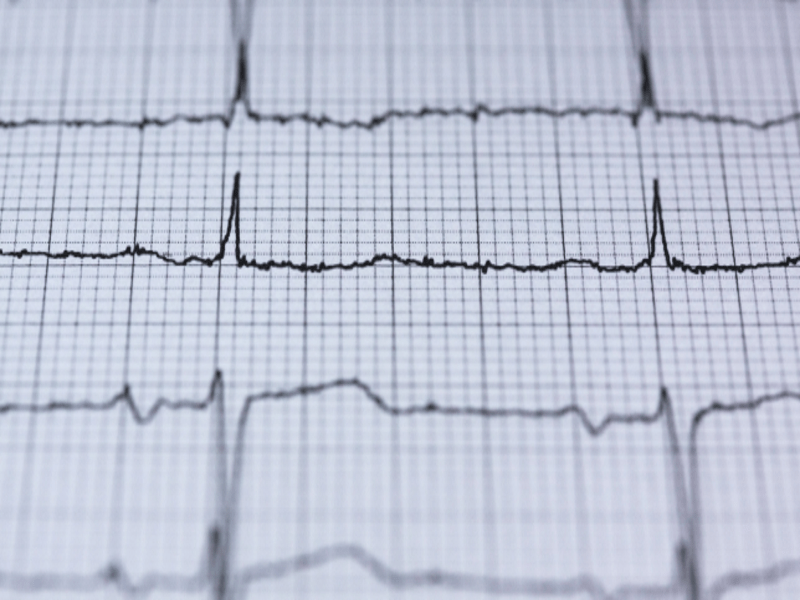 Three Key Trends in the Interventional Cardiology Market